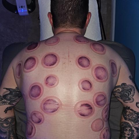 Cupping therapy