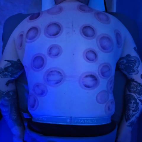 Cupping therapy